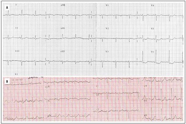 Postpartum Takotsubo cardiomyopathy: case report