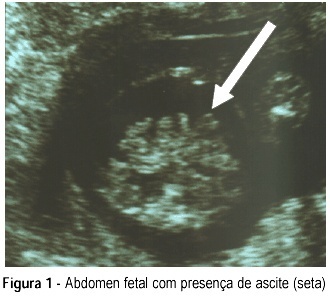 Congenital parvovirus infection: case report