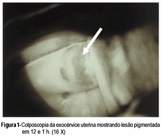 Compound nevus of the uterine cervix: case report