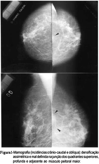 Sclerosing granular cell tumor of the breast simulating fibromatosis