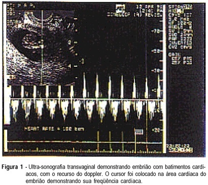 Index for the systemic treatment of unruptured ectopic pregnancy with a single dose of methotrexate