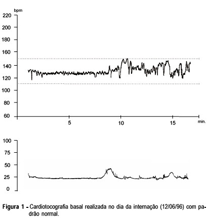 Fetal reanimation: a case report