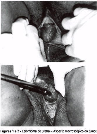 Leiomyoma of the female urethra: a case report