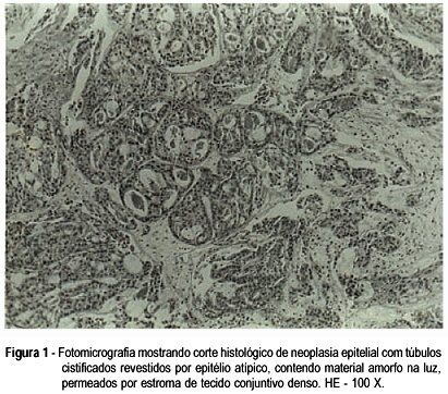 Clear Cell Adenocarcinoma of the Endocervix in a 7-year-old Child