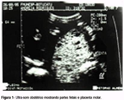 Complete Mole in Twin Pregnancy: a Case Report