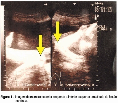 Prenatal diagnosis of arthrogryposis multiplex congenita: a case report