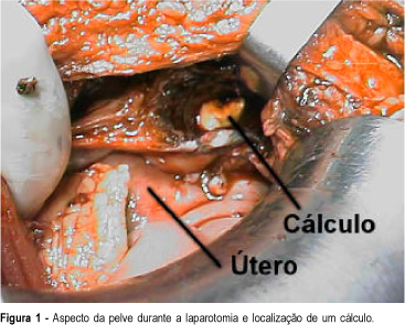“Lost” gallstone: a new problem for the gynecologist in acute abdomen management ?