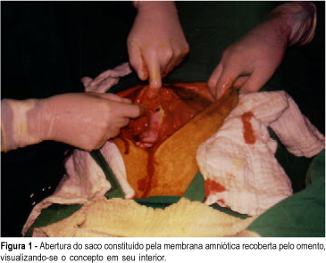 Abdominal pregnancy at term with live fetus: a case report
