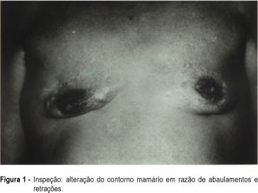 Dermatomyositis and Breast Calcinosis