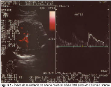 Vibro-acoustic stimulation induced hemodynamic fetal changes assessed by color doppler