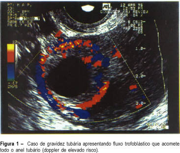 Transvaginal ultrasonography with color doppler to select the patients for conservative treatment of unruptured ectopic pregnancy