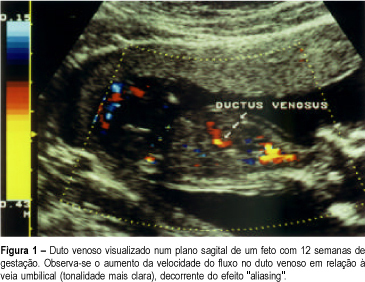 Reverse blood flow in ductus venosus: new perspective in detection of chromosomal abnormalities