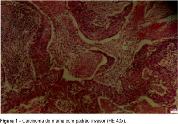 Squamous cell carcinoma of the breast tissue: a case report