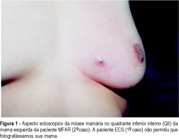 Breast myiasis: report of 2 cases