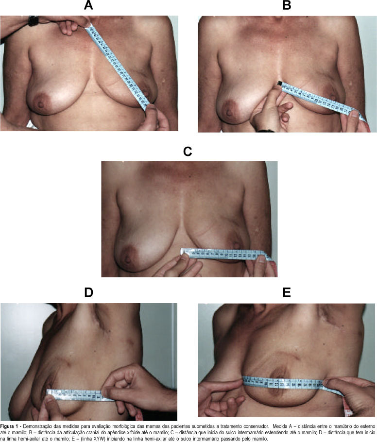 Analysis of Esthetic Results of Breast-conserving Treatment for Breast Cancer