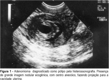 Role of Sonohysterography in the Evaluation of the Uterine Cavity in Patients with Abnormal Uterine Bleeding