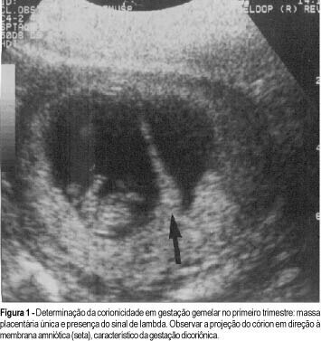 Fetal Malformations and Multiple Pregnancy