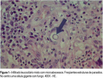 Mastitis due to Paracoccidioidomycosis: a Case Report