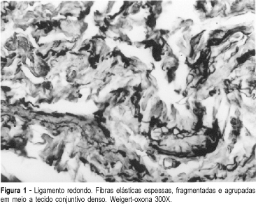 Elastic Fiber System Changes in the Endopelvic Fascia of a Young Patient with Uterine Prolapse – A Case Report