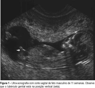 Identification of Fetal Gender by Ultrasound at 11th to 14th Weeks of Gestation