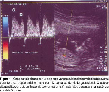 Doppler Velocimetry in Screening of Aneuploidy in the First Trimester of Gestation