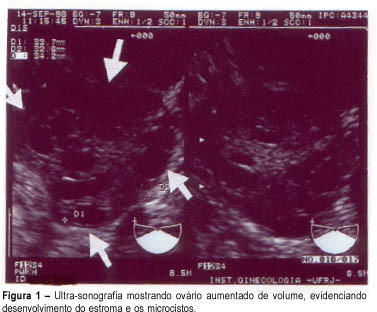 Polycystic Ovary Syndrome: Doppler Flow Measurement Evaluation