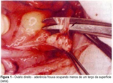Adhesion after partial resection and ovarian reconstruction of the ovary