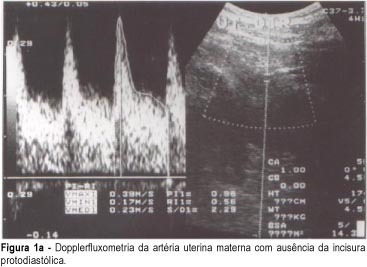 Association between Diastolic Notch of Uterine Artery and the Histology of the Placental Bed in Pregnant Women with Preeclampsia