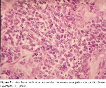 Small Cell Carcinoma of the Ovary with Hypercalcemia