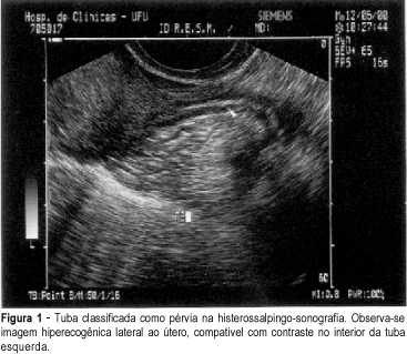 Hysterosalpingo-contrast Sonography in the Study of Tubal Patency in Infertile Women