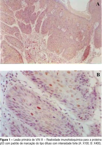 p53 Protein Overexpression as a Prognostic Marker for Vulvar Intraepithelial Neoplasia III Recurrence/Progression