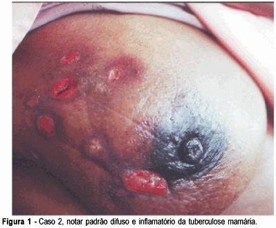 Primary Tuberculosis of the Breast
