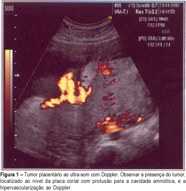 Placental tumor diagnosed in pregnancy: a case report