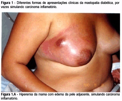 Diabetic Mastopathy: Uncommon Cause of Inflammatory Disease of the Breast