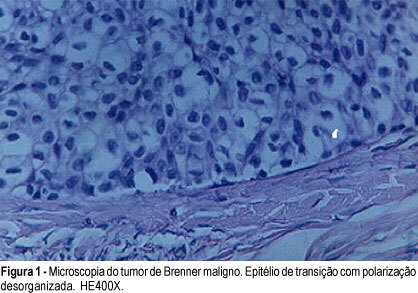 Brenner´s Benign and Malignant Tumor: A Case Report