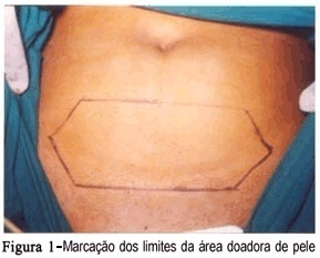 Vaginoplasty using full-thickness skin graft from the lower abdominal region