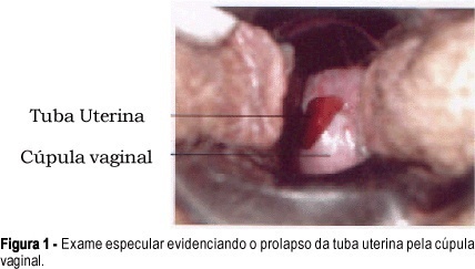 Fallopian tube prolapse after vaginal hysterectomy: a case report