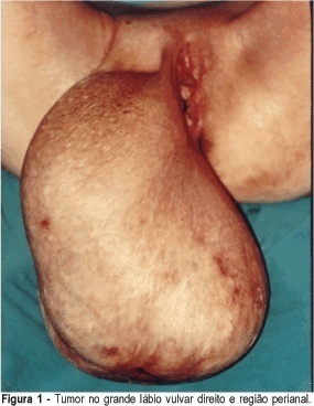 Vulval giant liposarcoma: a case report