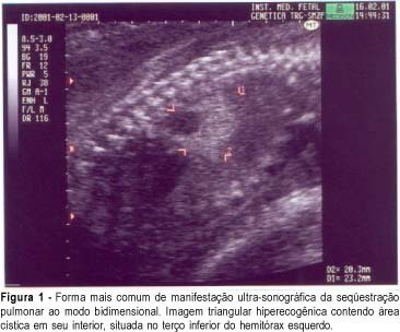 Prenatal diagnosis of pulmonary sequestration by ultrasound: a case report