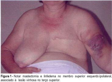 Stewart-Treves syndrome: case report