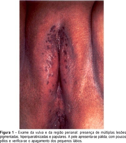 High-grade vulvar and perianal intraepithelial neoplasia treated with skinning vulvectomy: a case report