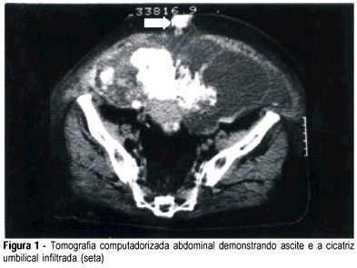 Sister Mary Joseph’s nodule: a warning sign for intra-abdominal malignant tumors. A case report
