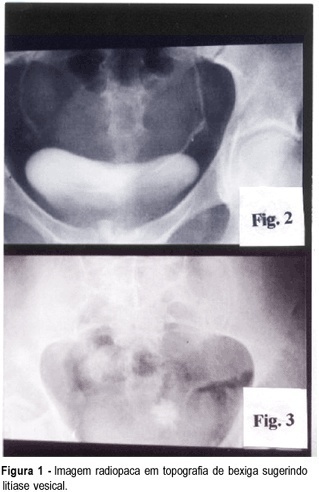 Vesicovaginal fístula caused by lithiasis: a case report