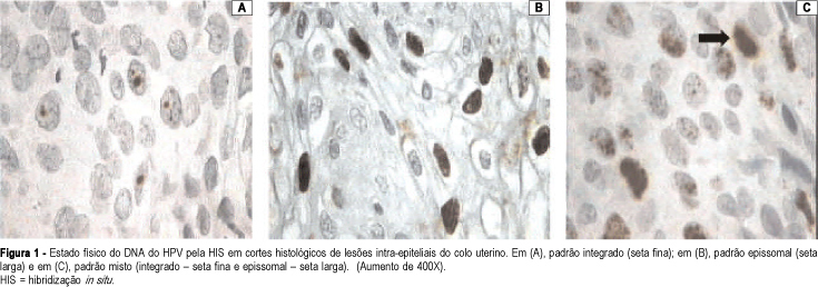 Human papillomavirus typing and physical state by in situ hybridization in uterine cervix intraepithelial lesions