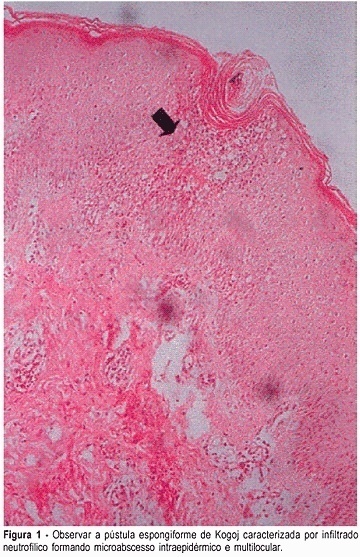 Pustular psoriasis of pregnancy (impetigo herpetiformis): a report of two cases and review of the literature