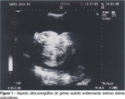 Umbilical artery occlusion as a therapeutic option in pregnancy with acardiac twin