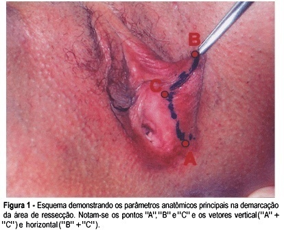 The use of the superior labial flap in the surgical correction of hypertrophy of labia minora