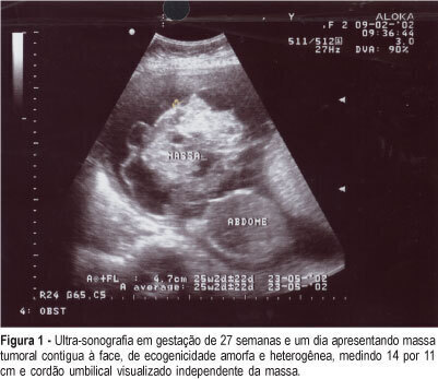Oropharyngeal congenital teratoma: a case report