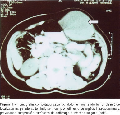 Desmoid tumor of the abdominal wall during pregnancy: a case report