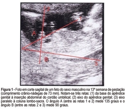 Sonographic determination of fetal gender by measurement of the angles of the genital tubercle